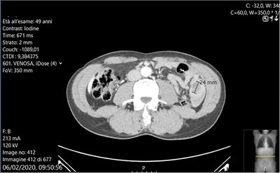 Small Bowel Intussusception Due to Rare Cardiac Intimal Sarcoma Metastasis: A Case Report